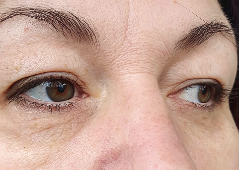 Eye area with crow's feet before neurotoxin treatment