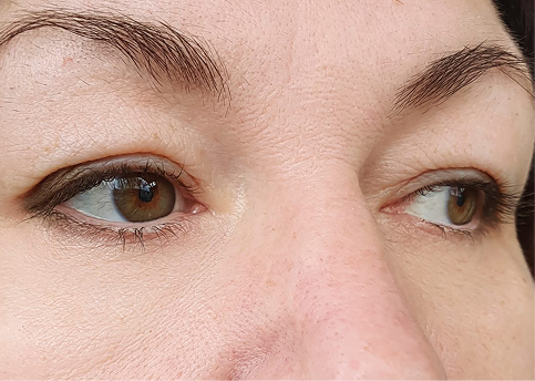 Eye area after neurotoxin treatment of crow's feet