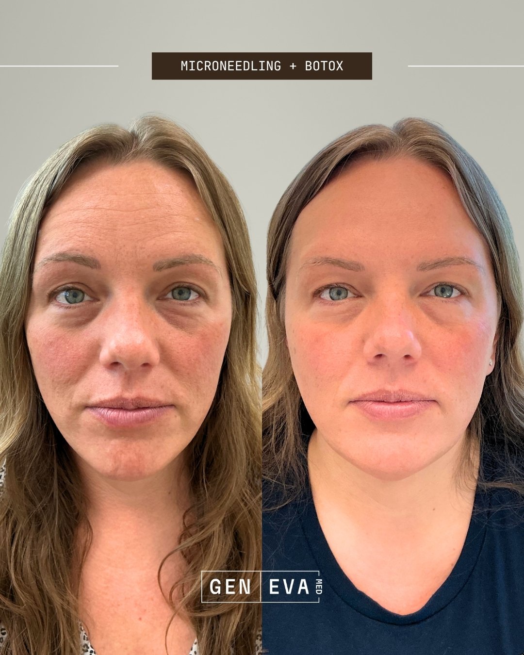 Microneedling and Botox before and after at GENEVA Med in Alpharetta