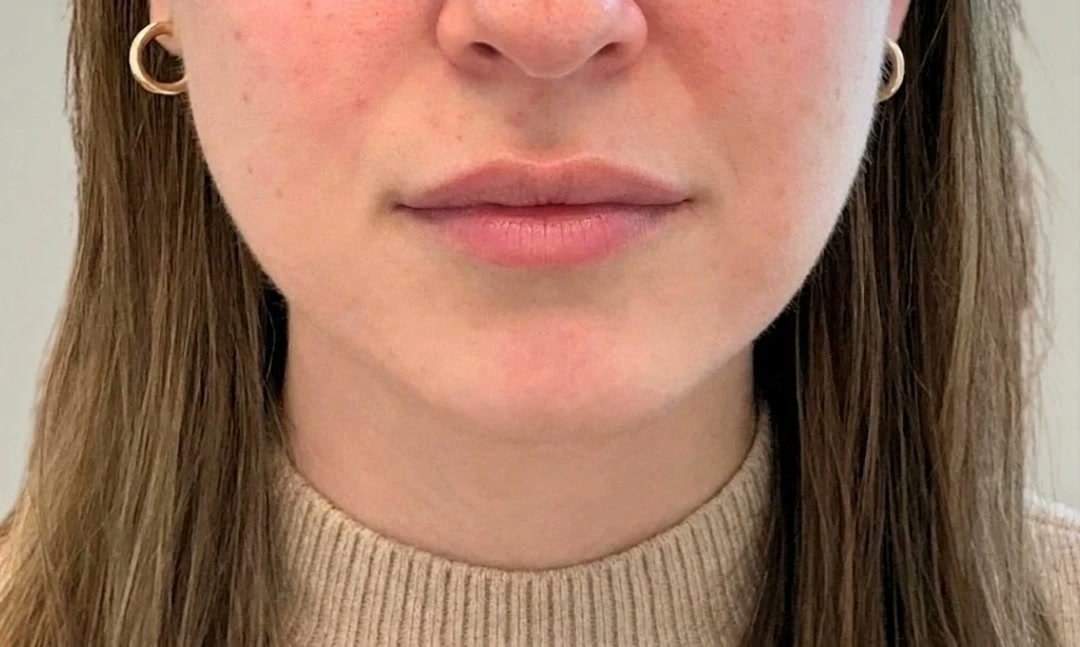 Lip filler after photo at GENEVA Med in Alpharetta