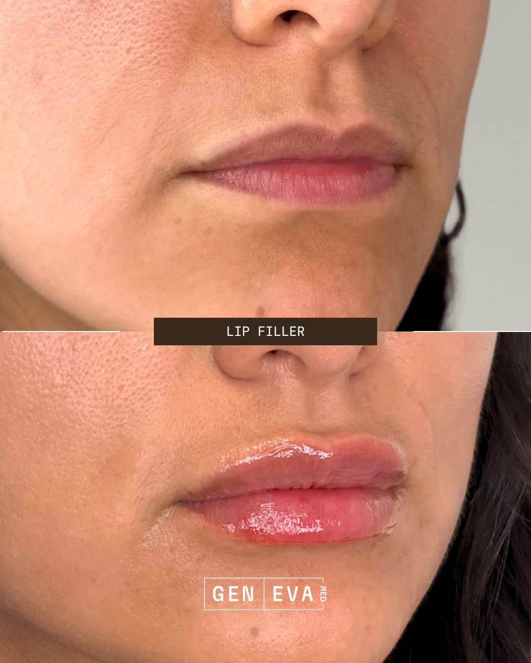 Lip filler before and after at GENEVA Med in Alpharetta