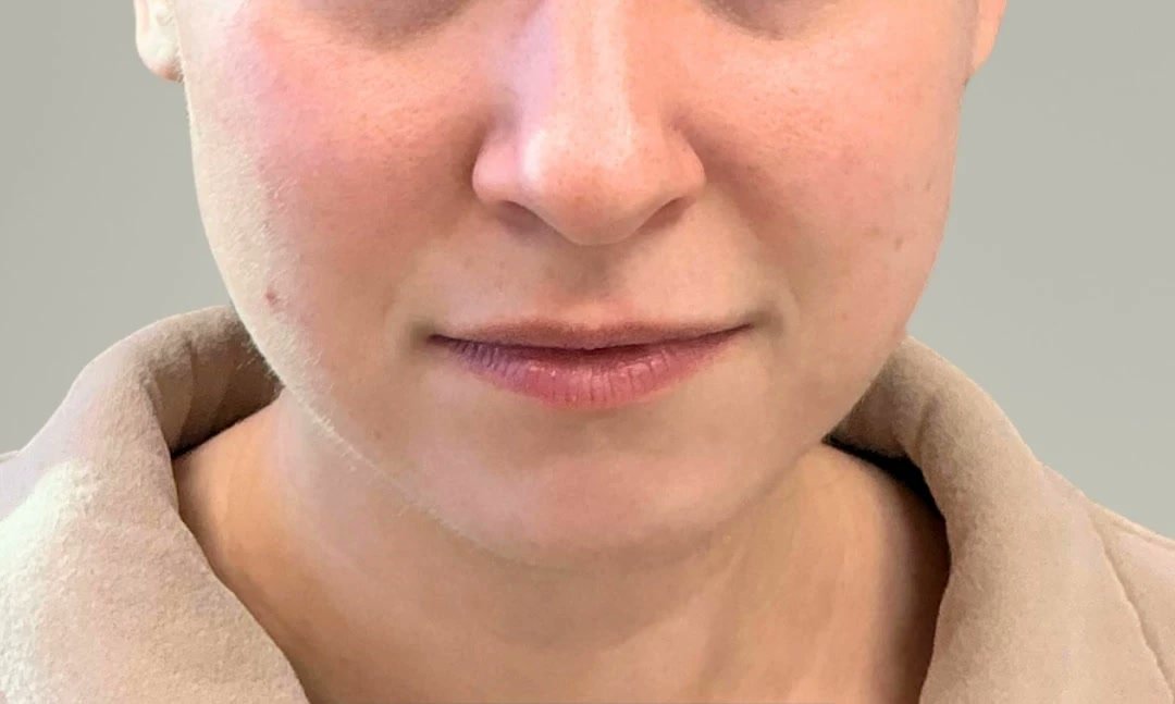 Lip filler before photo at GENEVA Med in Alpharetta