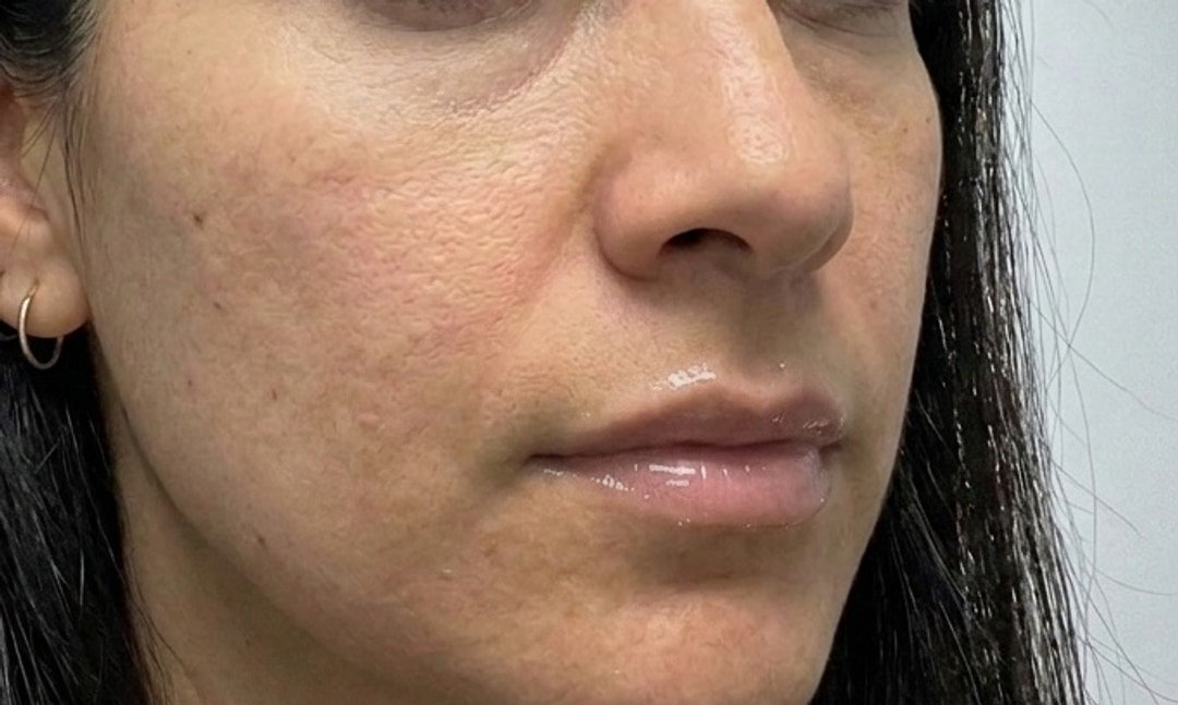 PRF and PRP skin rejuvenation after photo at GENEVA Med in Alpharetta