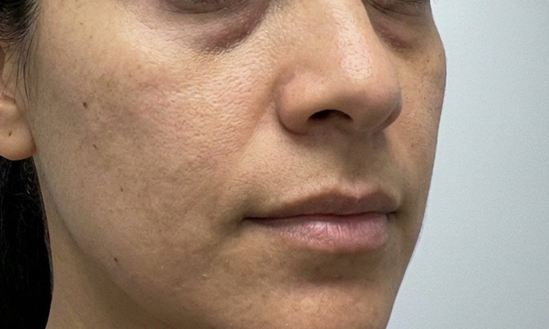 PRF and PRP skin rejuvenation before photo at GENEVA Med in Alpharetta