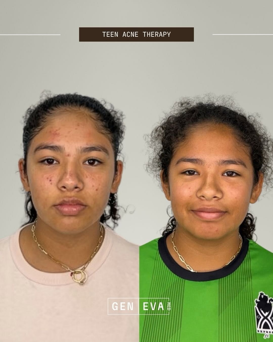 A teen patient before and after SKNLAB facial acne therapy at GENEVA