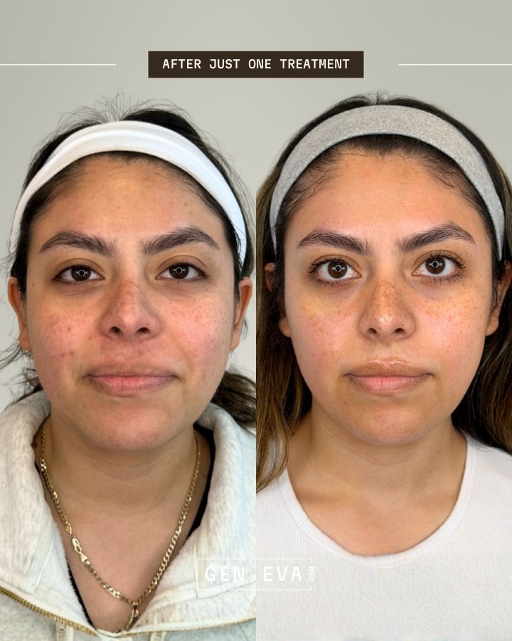 Ashley V. before (left) and after (right) one CoolPeel laser resurfacing session, front view