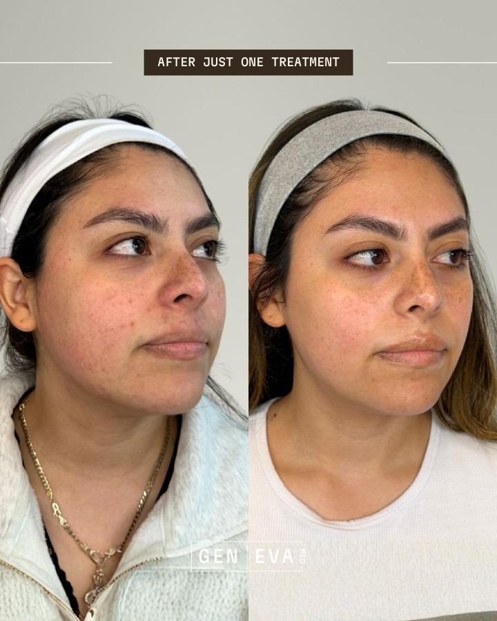 Ashley V. before (left) and after (right) one CoolPeel session, side view